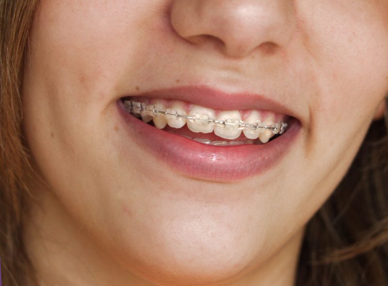 Differences Between Braces And Invisalign